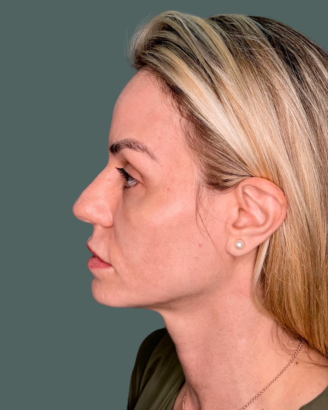 After Image: Melasma - left-side