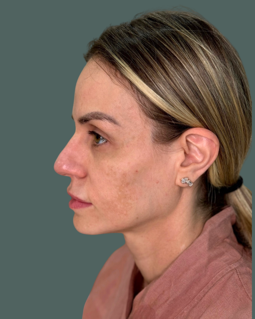 Before Image: Melasma - left-side