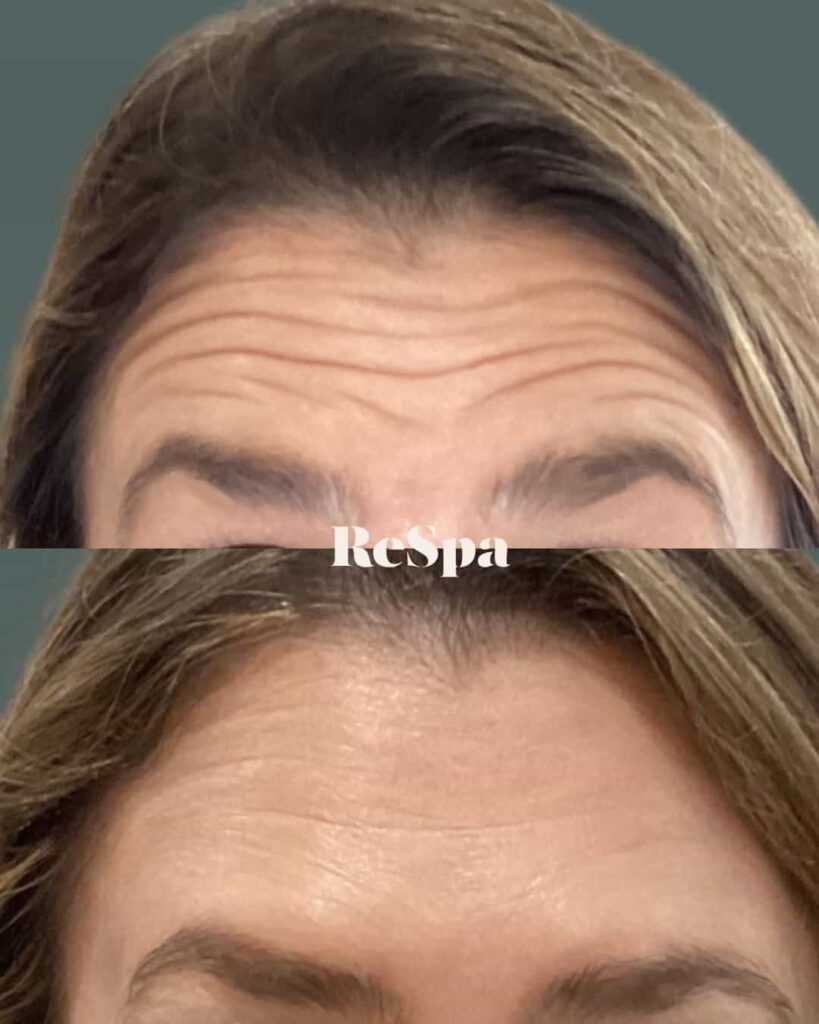 Before and After Image: Neurotoxin - front