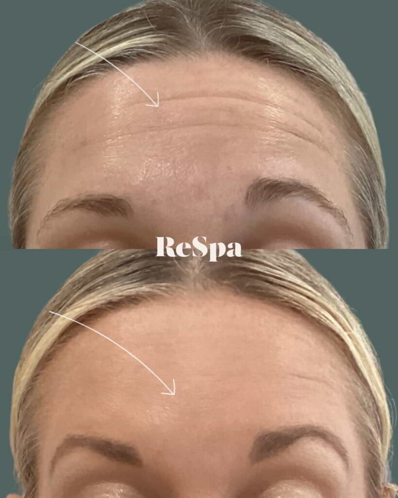 Before and After Image: Neurotoxin - front