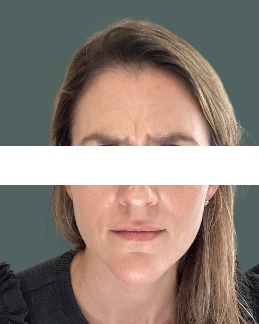 Before Image: Neurotoxin - front