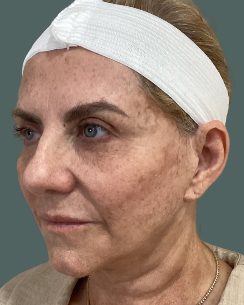 Before Image: Microneedling with PRP, Dermal Filler & VI Peel - left-front-oblique