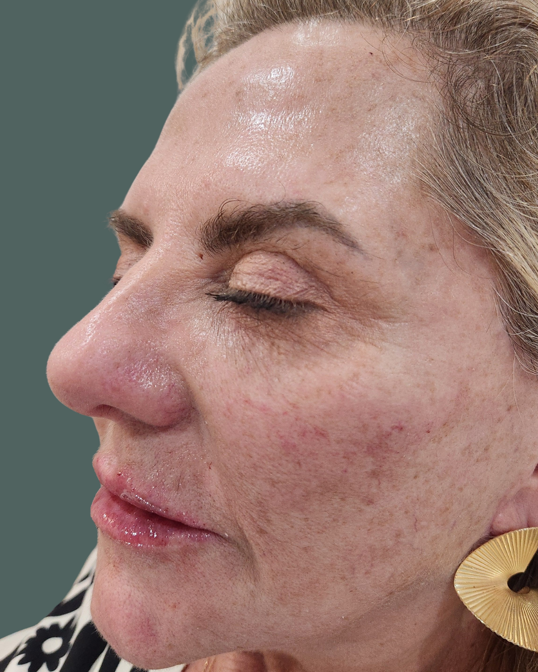 After Image: VI Peel - left-front-oblique