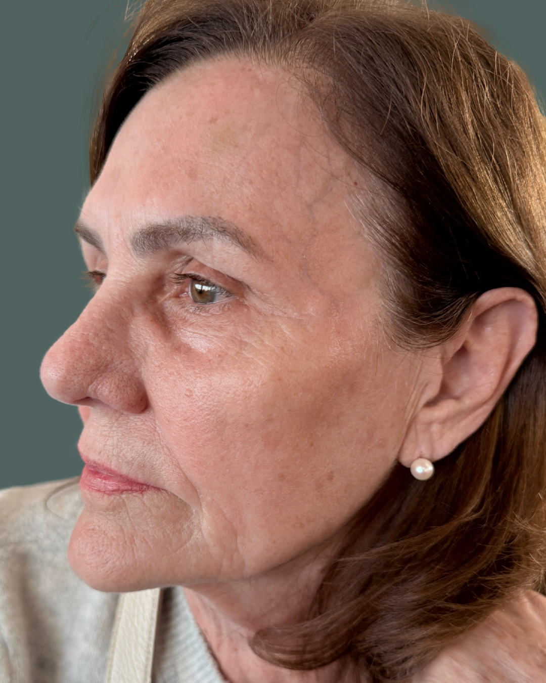 After Image: VI Peel - left-front-oblique