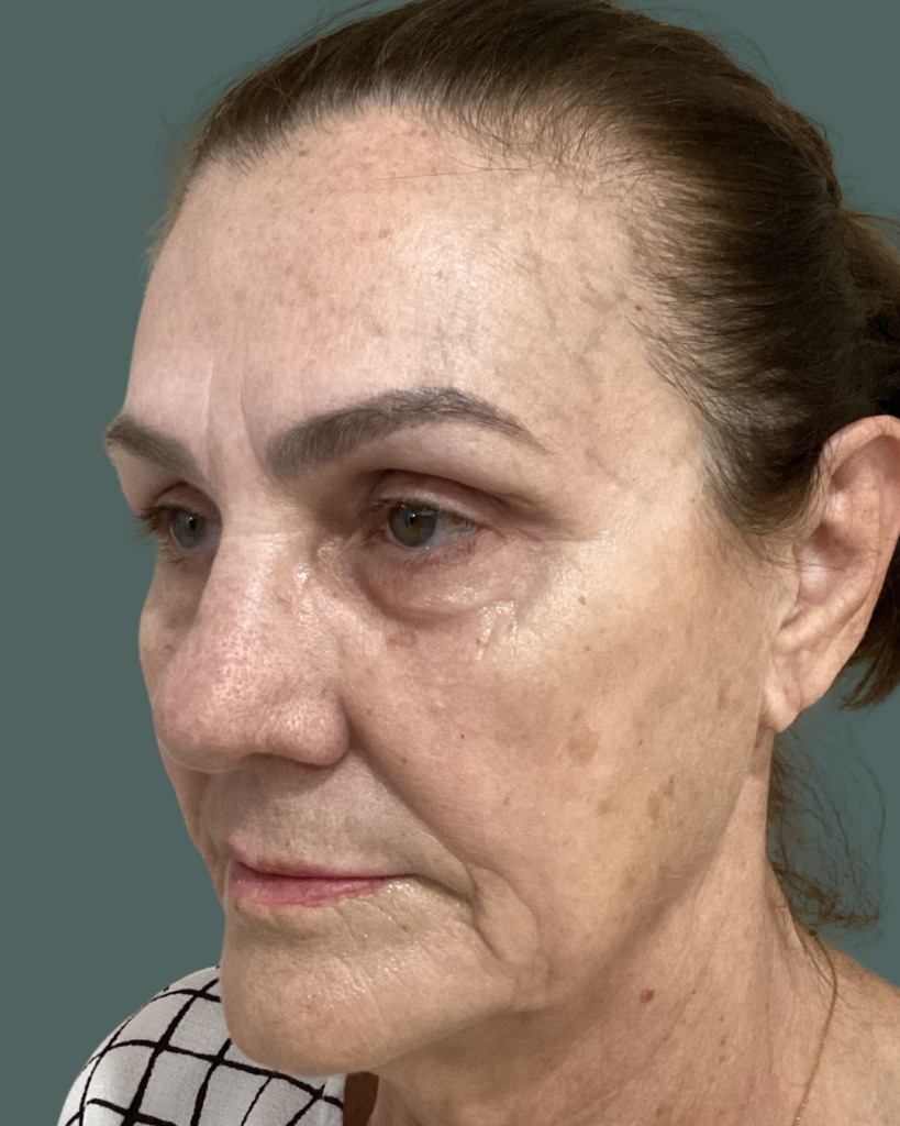 Before Image: VI Peel - left-front-oblique