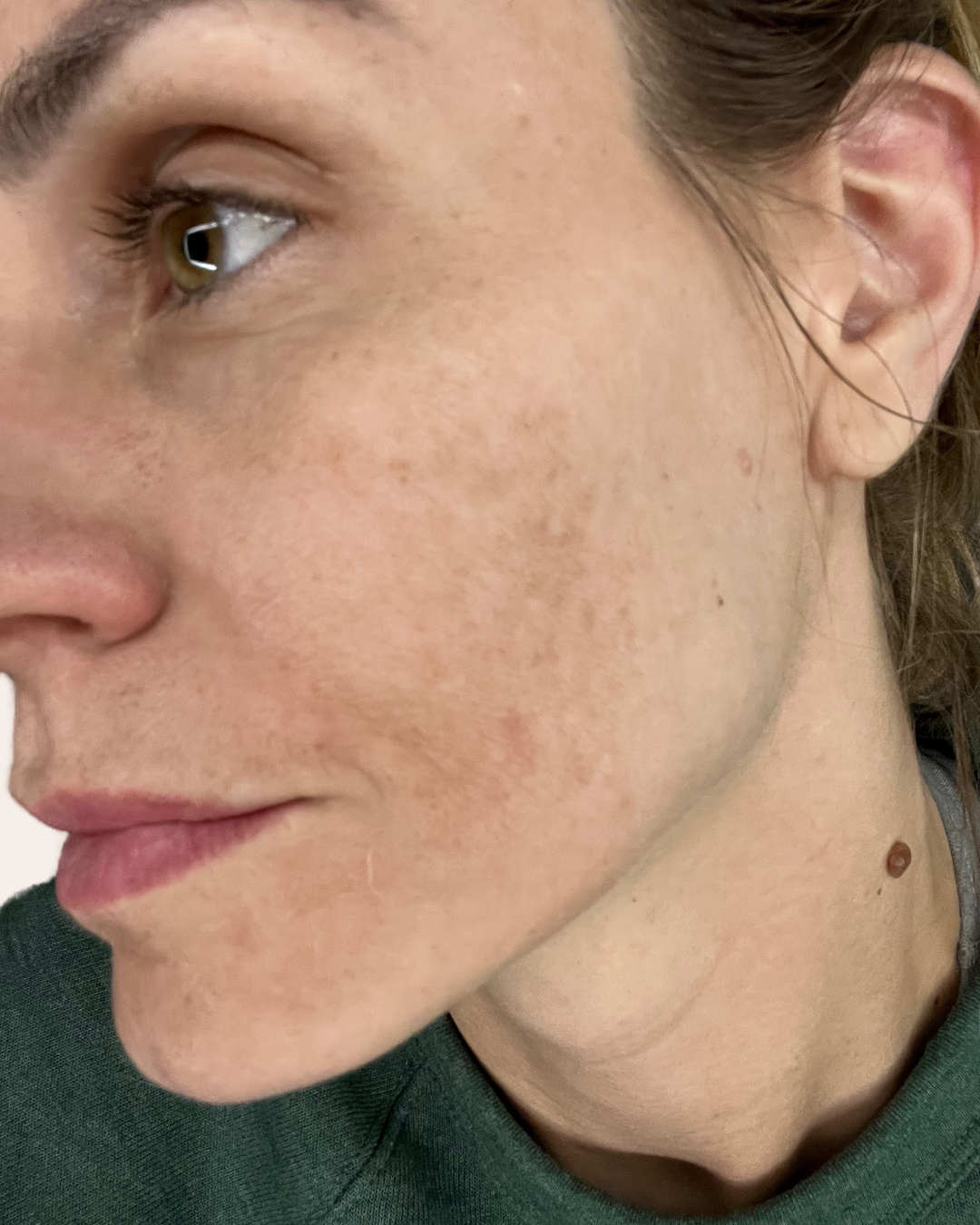 Before Image: VI Peel - left-front-oblique