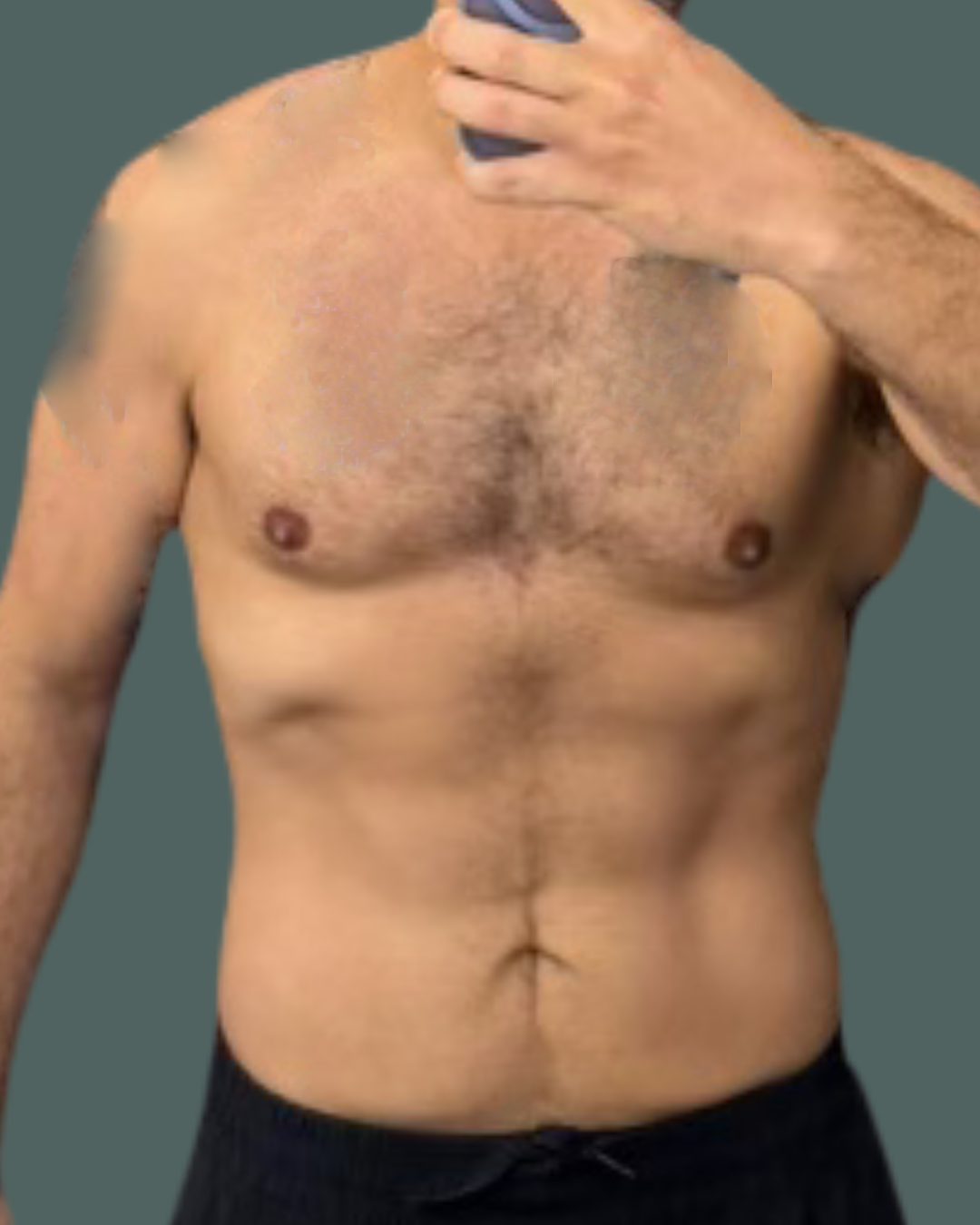 After Image: Weight Loss and Emsculpt NEO - front