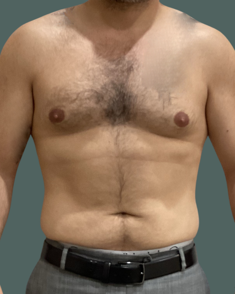 Before Image: Weight Loss and Emsculpt NEO - front