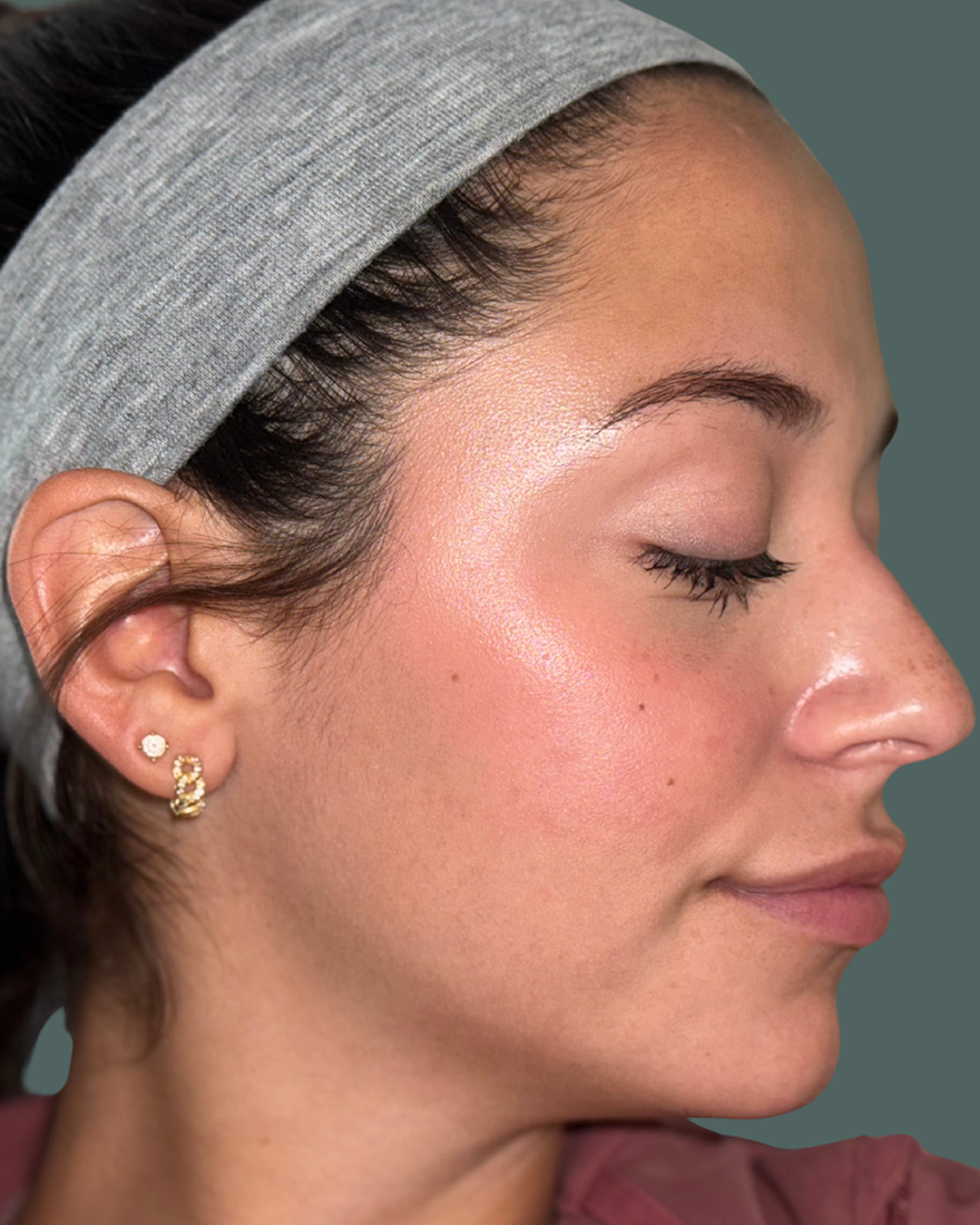 After Image: Acne Bootcamp - right-front-oblique