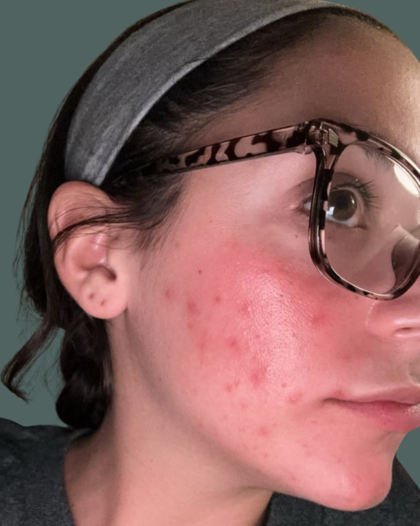 Before Image: Acne Bootcamp - right-front-oblique