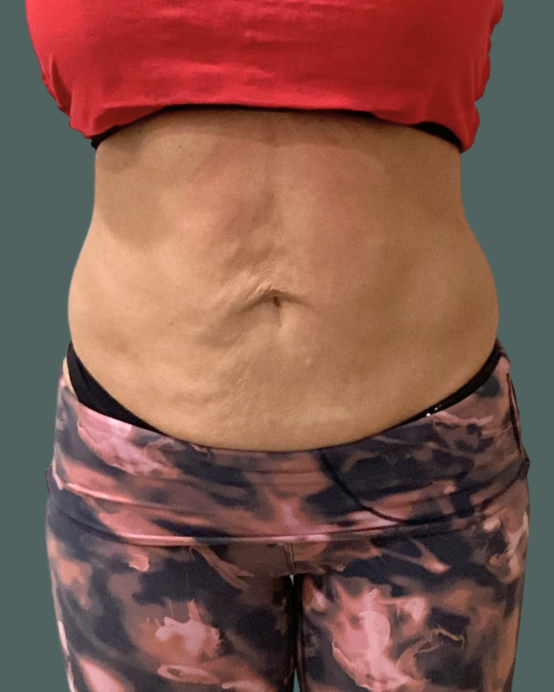 Before Image: Emsculpt NEO + RF Microneedling - front