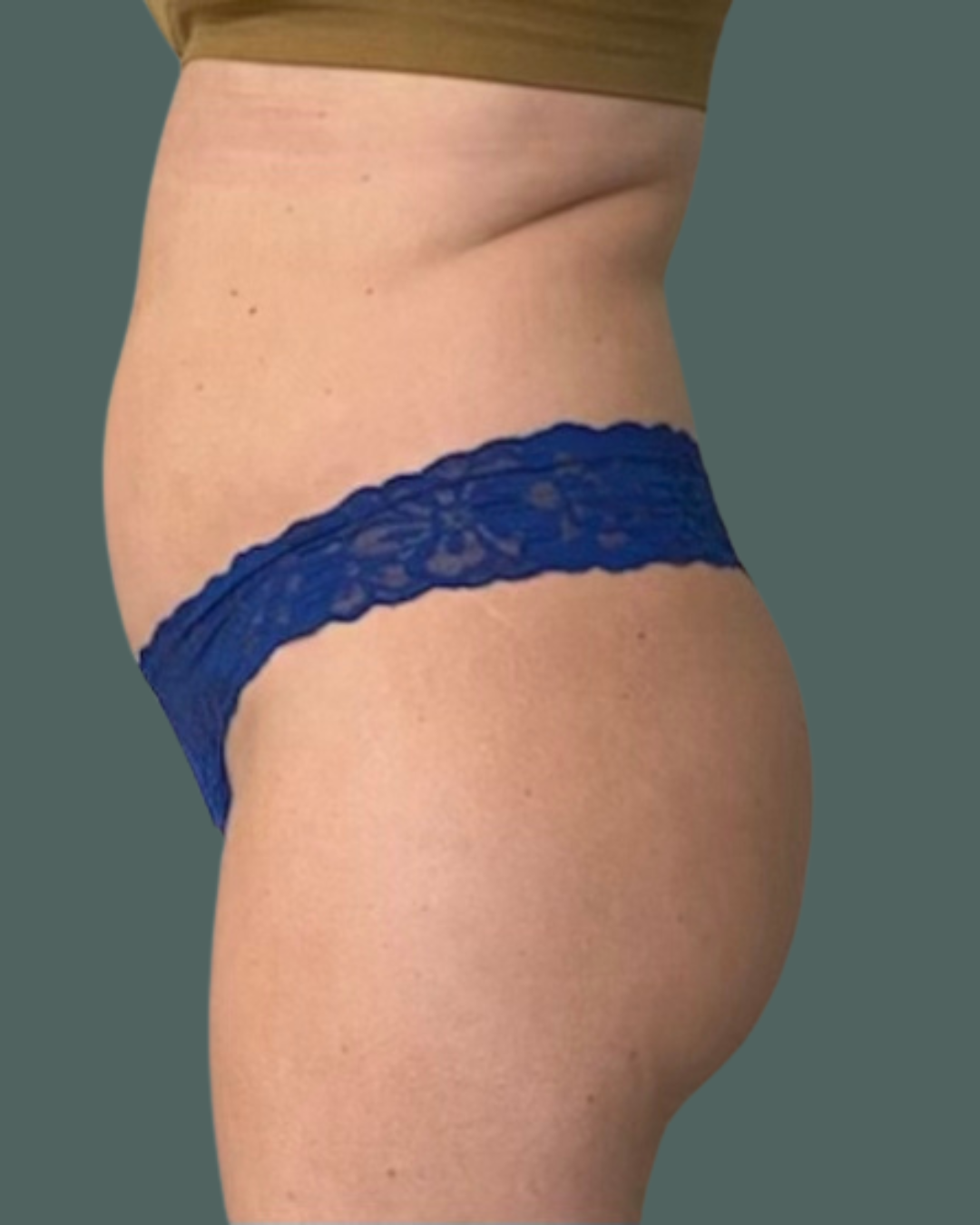 Before Image: Maternal Reset - left-side