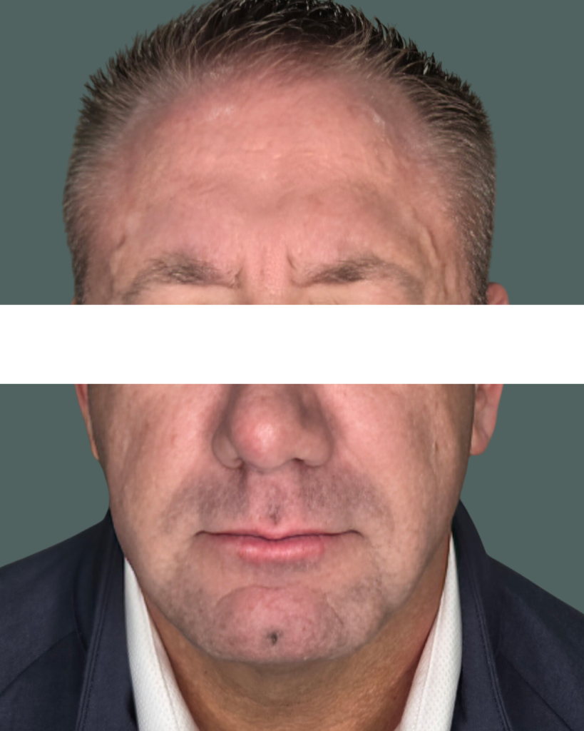 After Image: BOTOx - front