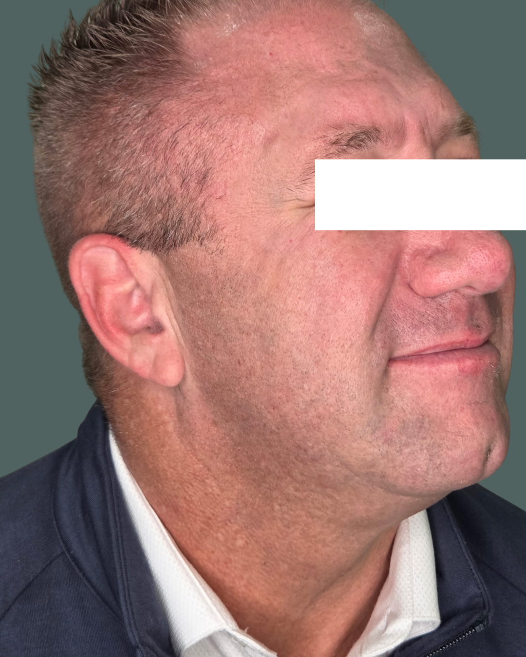 After Image: BOTOx - right-side