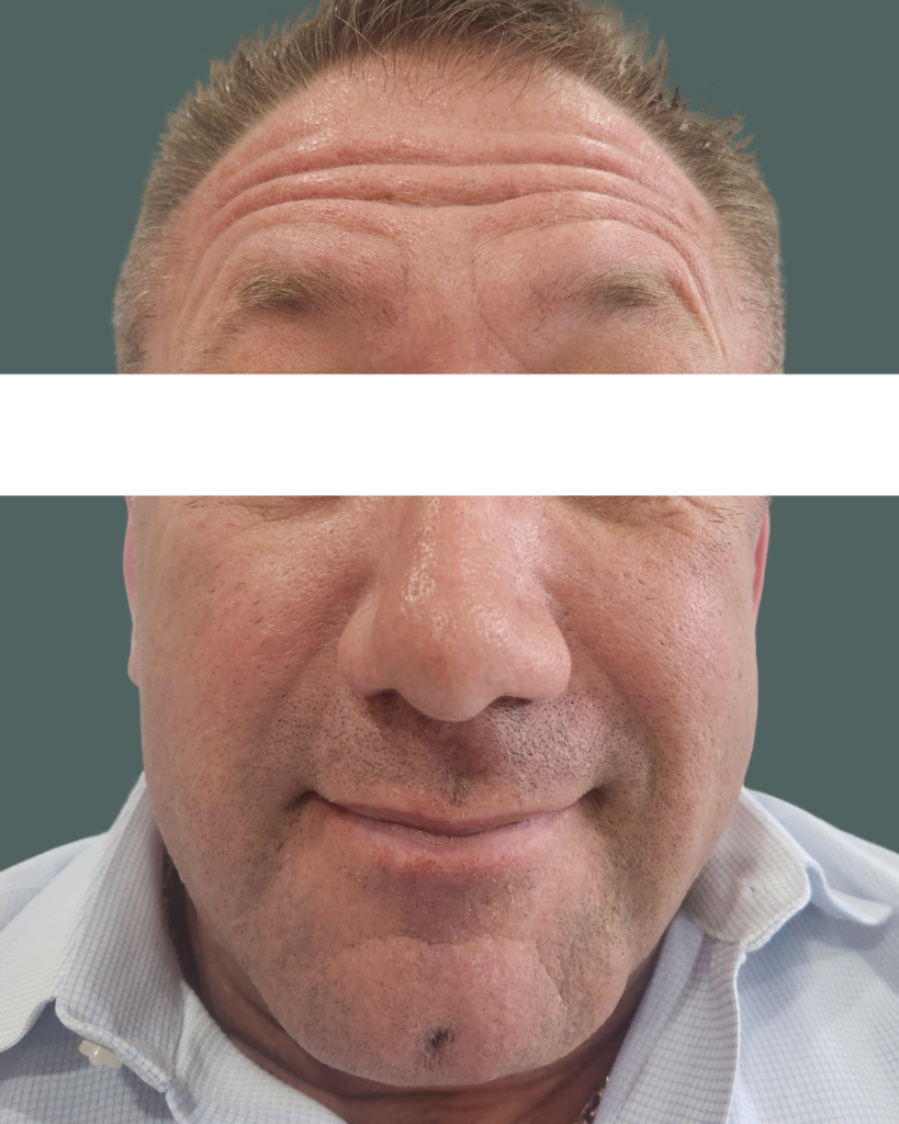 Before Image: BOTOx - front