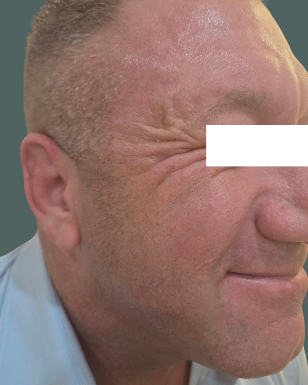 Before Image: BOTOx - right-side