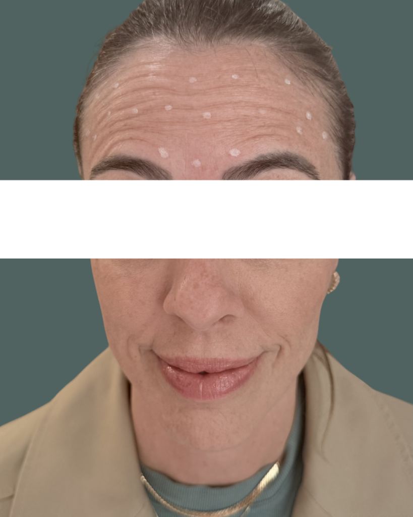 Before Image: Neuromodulators - front
