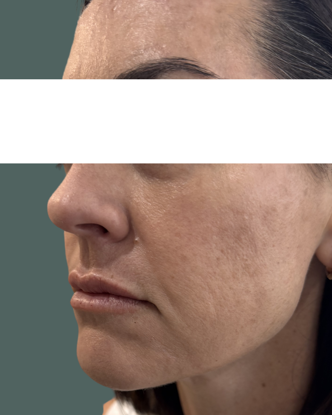 After Image: Dermal Filler - left-side