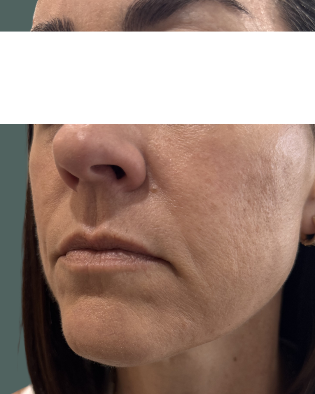 Before Image: Dermal Filler - left-side