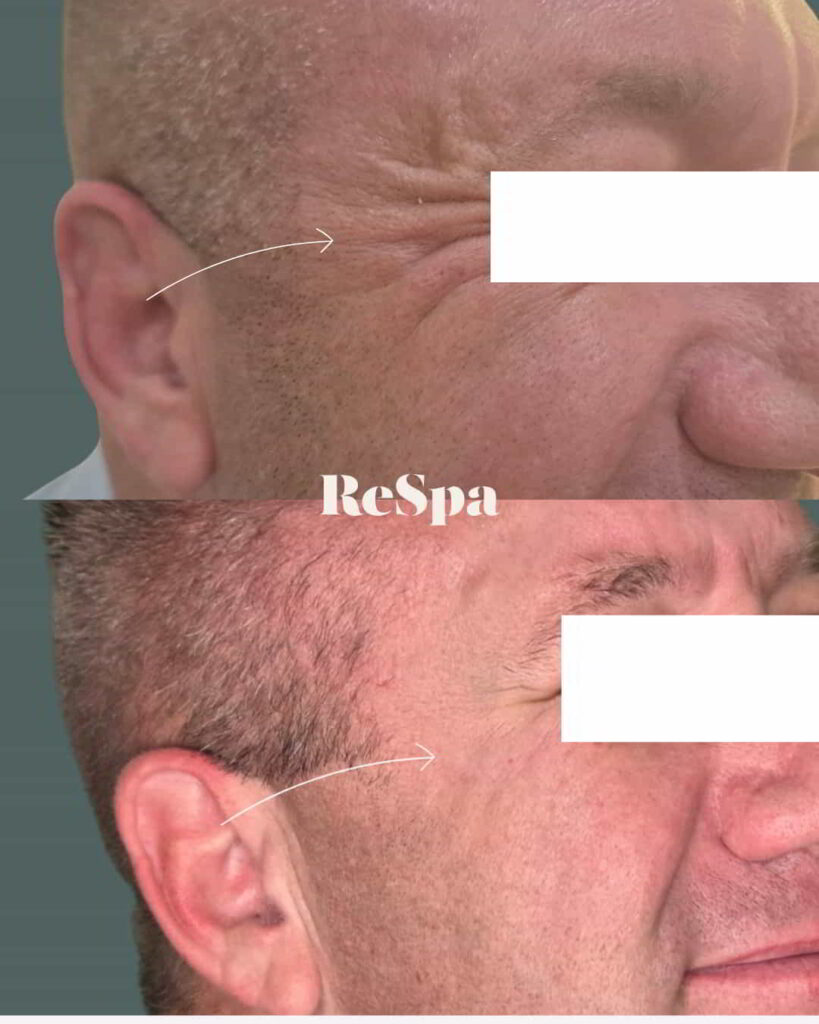 Before and After Image: Neurotoxin - right-side