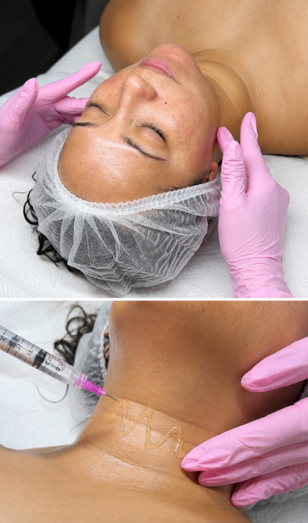 PRX Derm Perfexion in Palm Beach: The No-Downtime Secret to Tighter, Brighter, Glass Skin