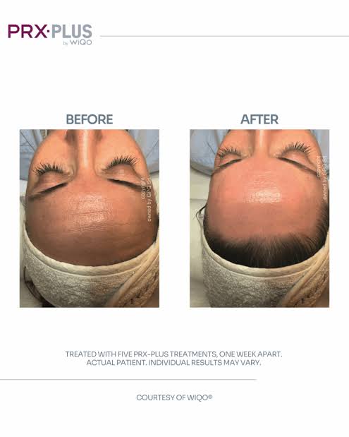 PRX Derm Perfexion in Palm Beach, FL