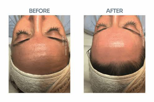 PRX Derm Perfection in Palm Beach: The No-Downtime Secret to Tighter, Brighter, Glass Skin