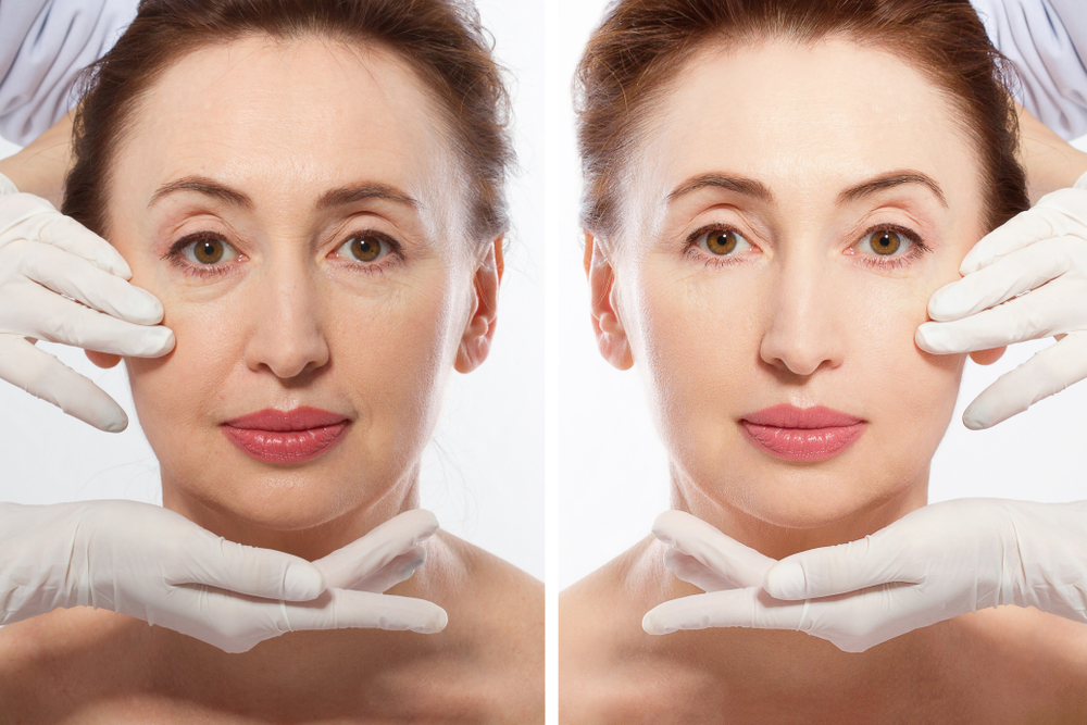 Before-and-after dermal filler treatment results on a woman's face.