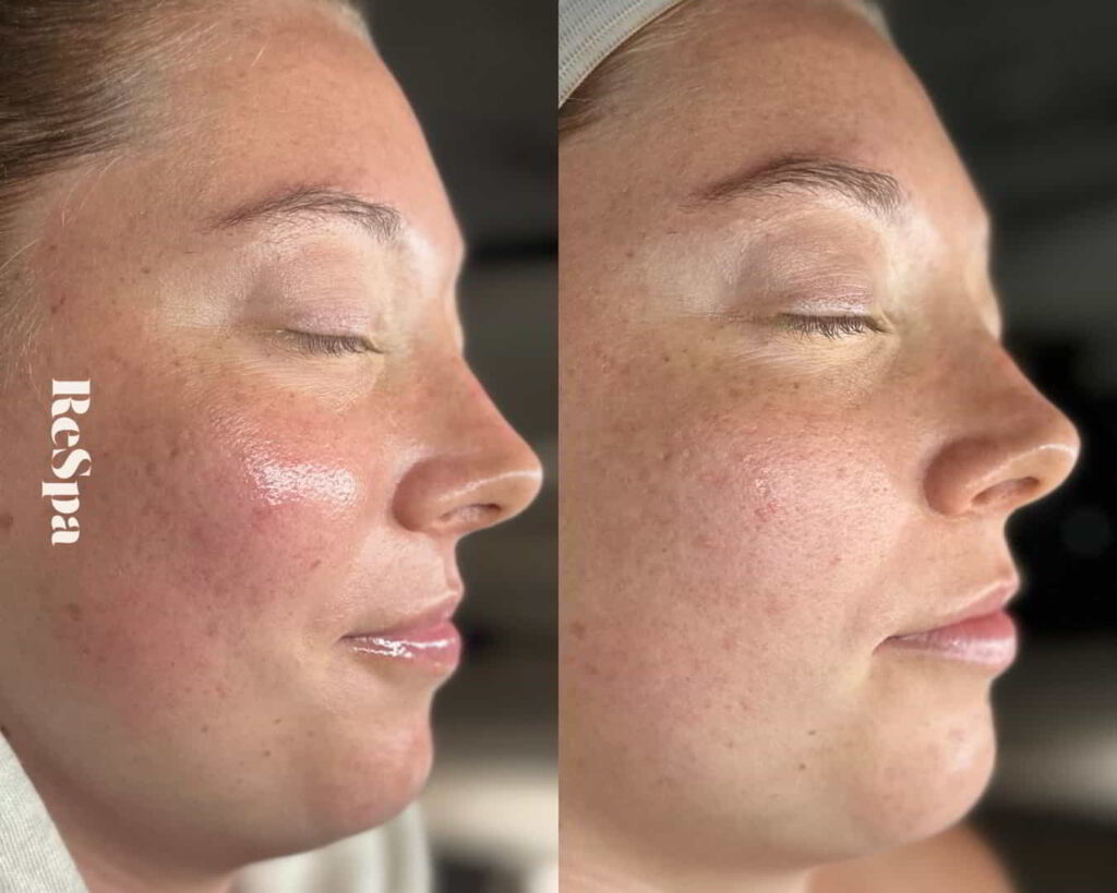 Before and After Image: Facial  - front