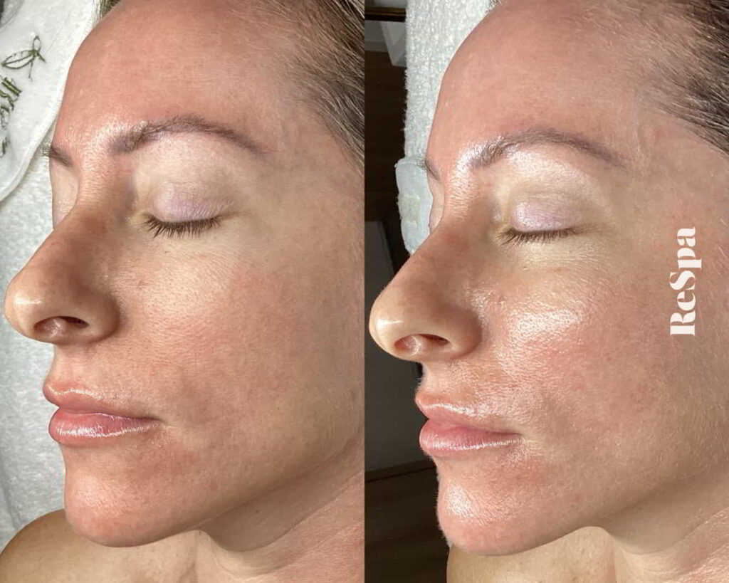 Before and After Image: Facial  - front