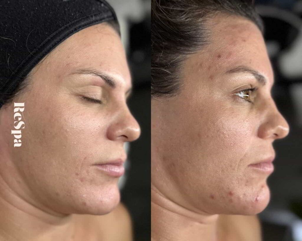 Before and After Image: Facial  - front