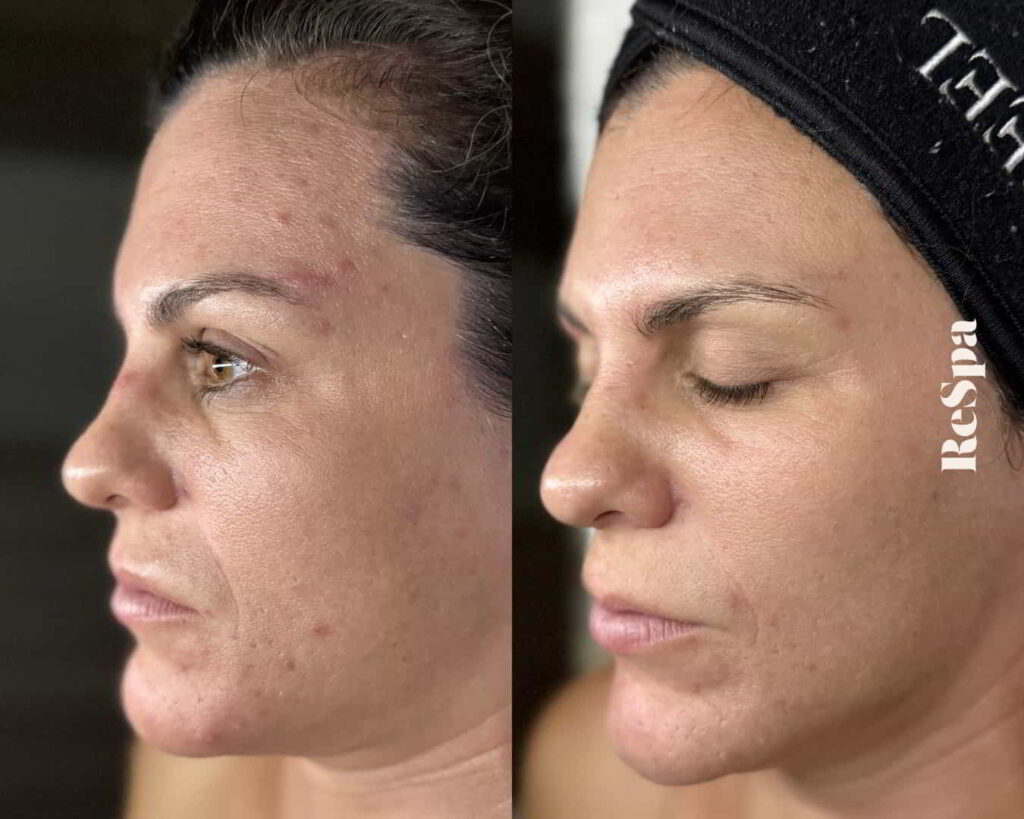 Before and After Image: Facial  - front