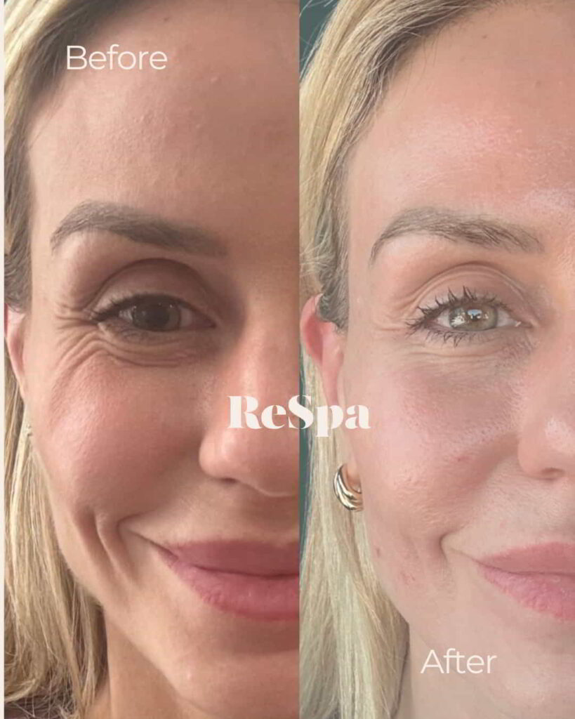 Before and After Image: Sculptra: 4 Vials - front