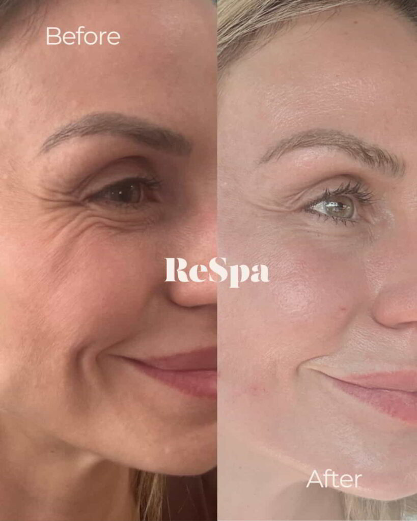 Before and After Image: Sculptra: 4 Vials - right-front-oblique