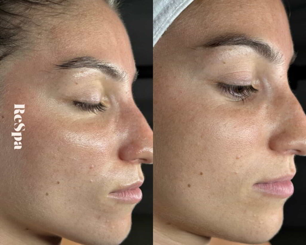 Before and After Image: Facial  - front