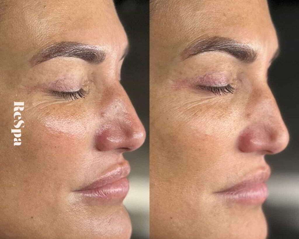 Before and After Image: Facial  - front