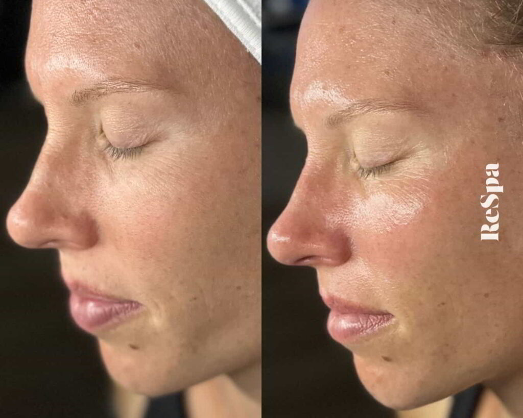 Before and After Image: Facial  - front