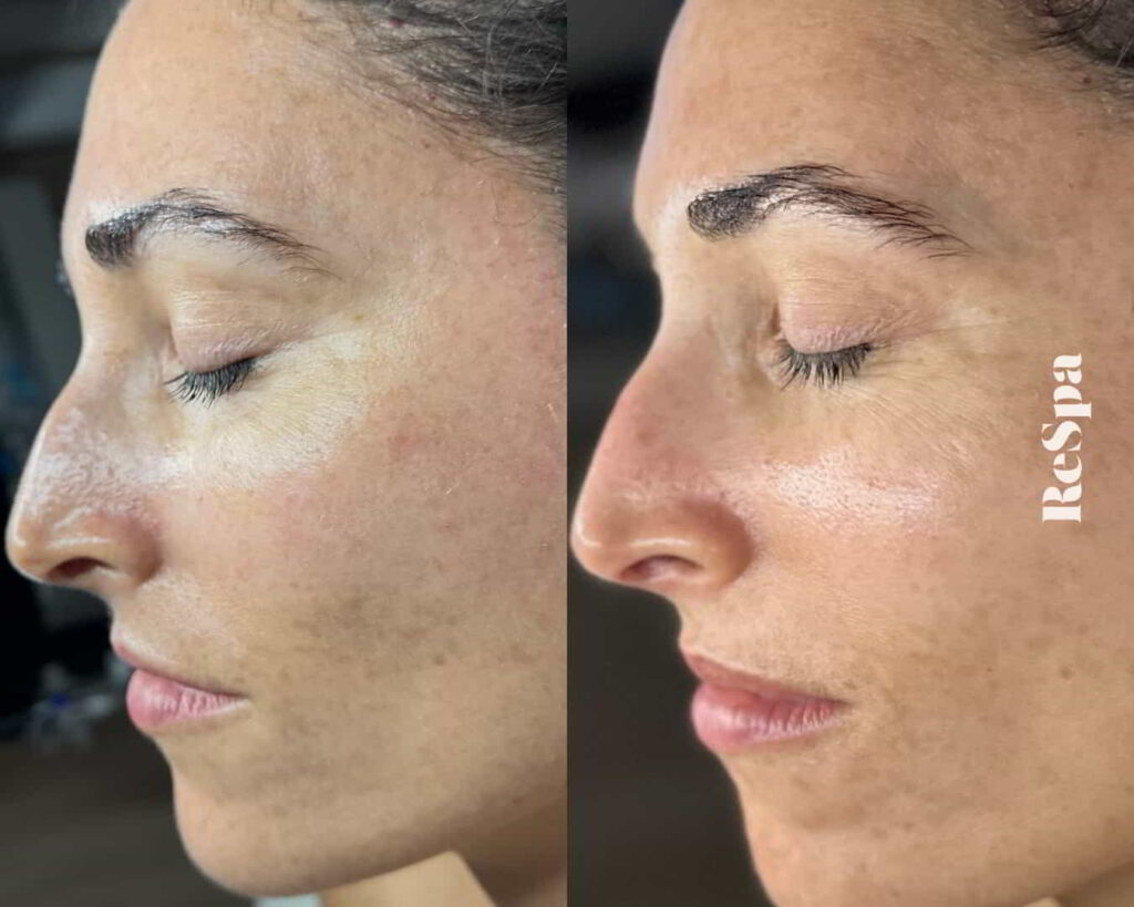Before and After Image: Facial  - front