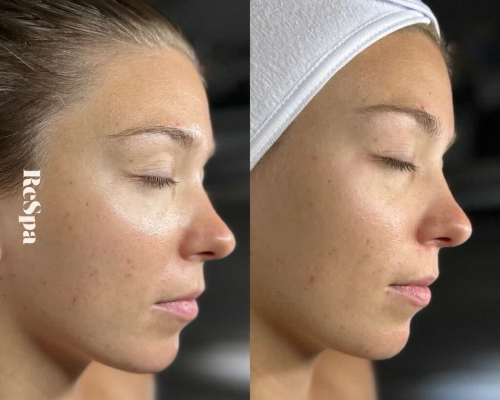 Before and After Image: Facial  - front