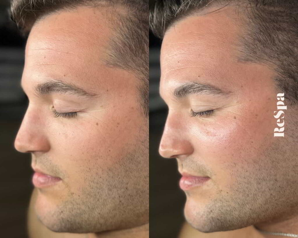 Before and After Image: Facial  - front