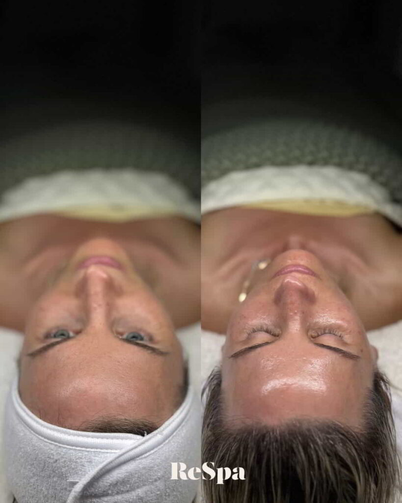 Before and After Image: Facial  - front