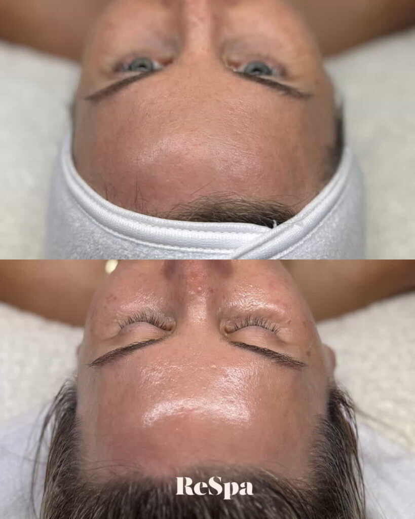Before and After Image: Facial - front