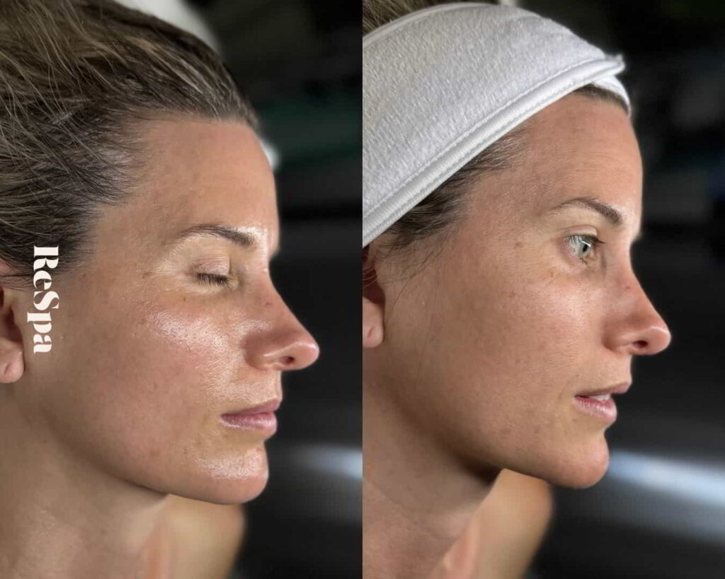 Before and After Image: Facial  - front