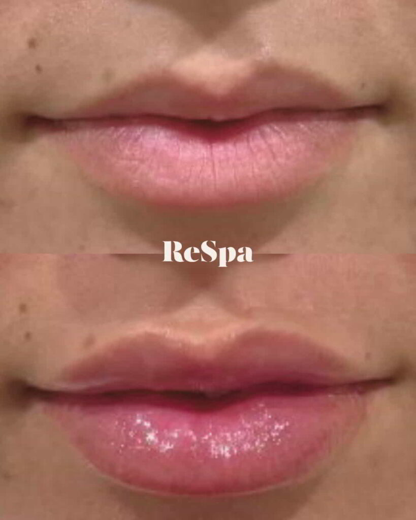Before and After Image: Lip Fillers - front
