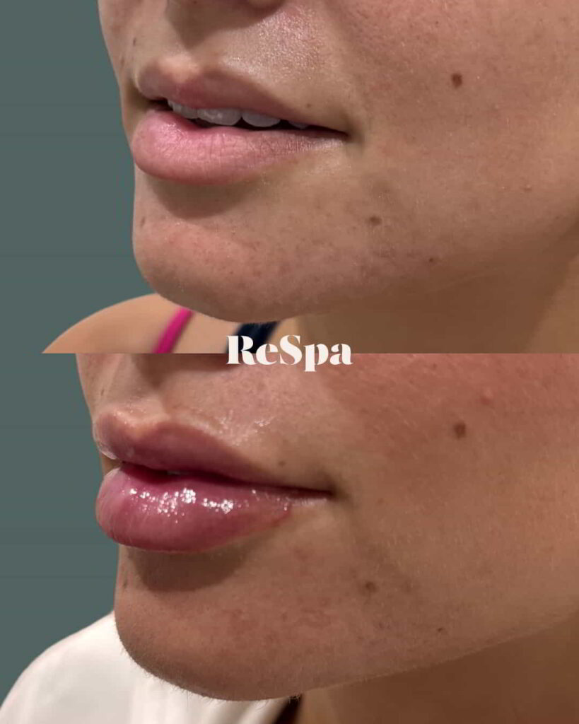 Before and After Image: Lip Fillers - left-front-oblique