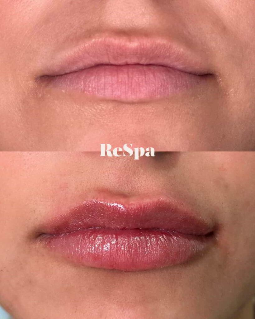 Before and After Image: Lip Fillers - front