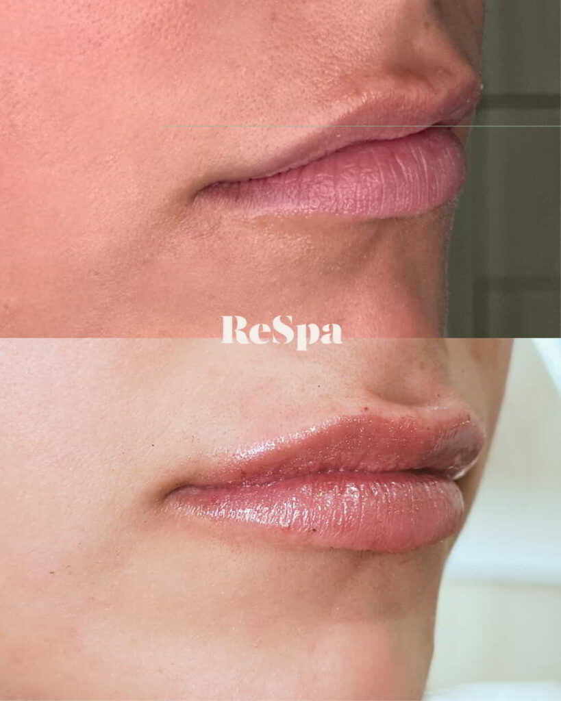 Before and After Image: Lip Fillers - right-front-oblique