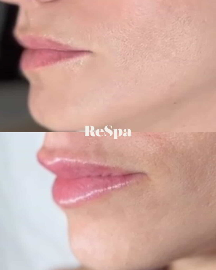 Before and After Image: Lip Fillers - left-front-oblique