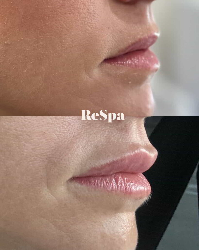 Before and After Image: Lip Fillers - front