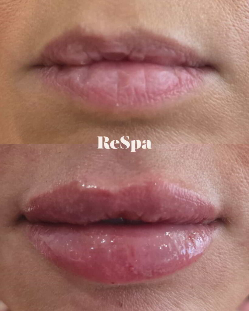 Before and After Image: Lip Fillers - front